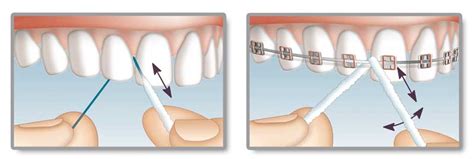 Mirafloss Implant Hager Werken