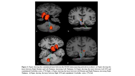 Study Of Age Related Neurodegeneration Of Cerebellum Basal Ganglia