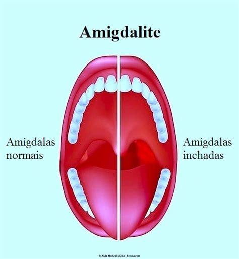 Sintomas Da Amigdalite Aguda Ou Cr Nica Rem Dios E Tratamento