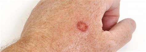 What Are The Symptoms Of Skin Cancer Sores? - SKIN 4 CARES