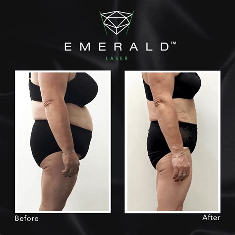 Emerald Laser Emerald Laser Fat Removal Drbk