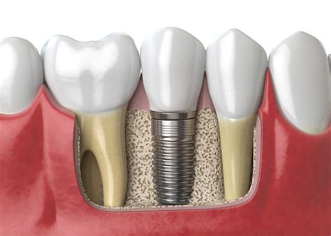 Quali sono le fasi dell'impianto dentale? | Dottor Ale