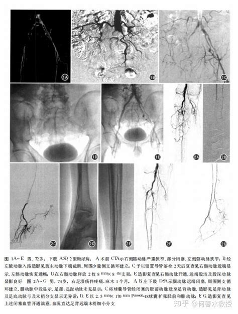 血管腔内介入治疗下肢动脉硬化闭塞症的临床研究 知乎