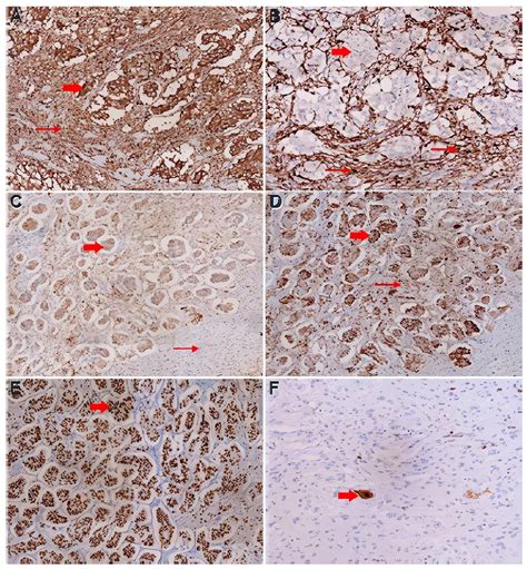 Paraganglioma Gangliocítico Metastásico Neoplasia Duodeno