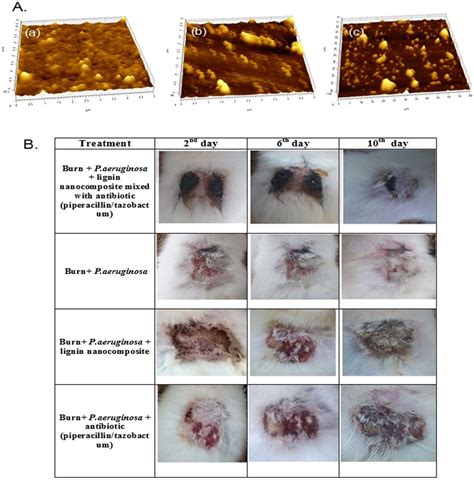 Pseudomonas Aeruginosa Burn Infection