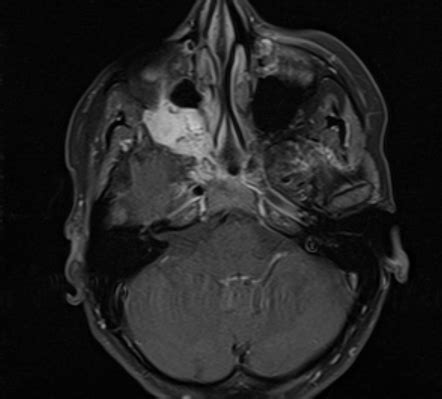 Adenoid Cystic Carcinoma Maxillary Sinus Radiology Case