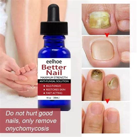 Eelhoe Fungal Nail Repair Essence Serum Care Treatment Foot Nail Fungus