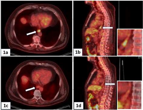 Pre Treatment 1a 1b And Post Treatment 1c 1d PET Images Of A