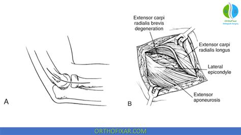 Tennis Elbow Surgery Orthofixar 2025