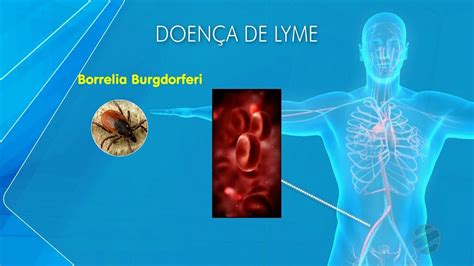 Vídeo Doença de Lyme entenda as causas e sintomas da doença que