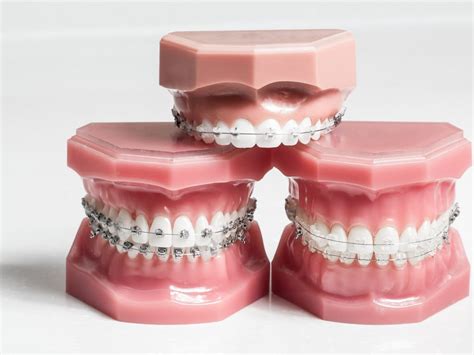 Les gouttières invisibles Spark Orthodontiste Corbeil Essonnes