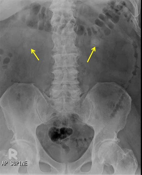 Renal abscesses – Radiology Cases