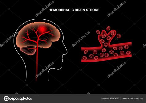 Brain Stroke Hemorrhagic Stock Vector By Pikovit 481454626