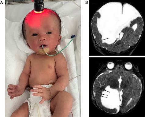 Diagnosis Of Hydrocephalus By Cranial Transillumination Adc Fetal