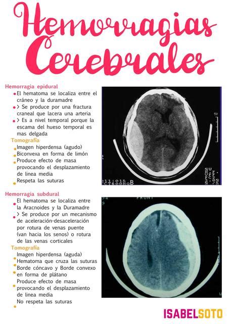 Hemorragias Cerebrales Isabel Soto Daza UDocz