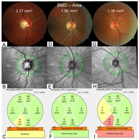 Jcm Free Full Text Evaluation Of Retinal Nerve Fiber Layer And