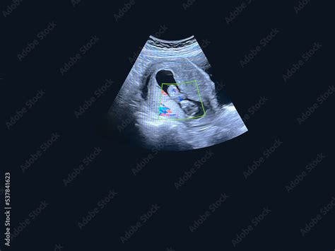 Little baby ultrasound at 8 weeks gestation ultrasound images of the ...