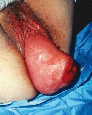 UTERINE PROLAPSE Porn Pictures XXX Photos Sex Images 4011040 PICTOA