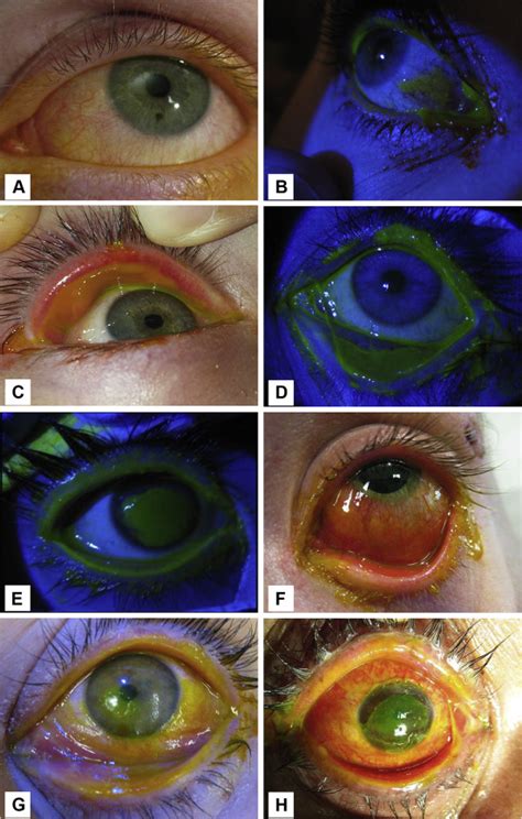 New Grading System And Treatment Guidelines For The Acute Ocular