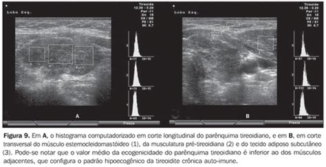 Radiologia Brasileira Import Ncia Da Ecogenicidade Da Tire Ide No