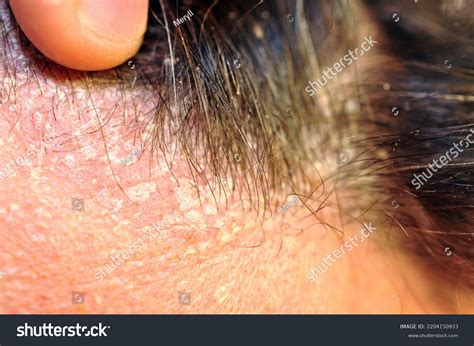 Стоковая фотография 2204150933 Seborrhea Seborrheic Dermatitis Skin