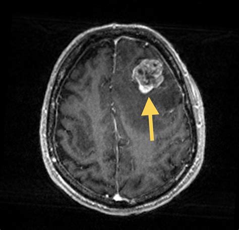 Metastasis Matthew Mian MD