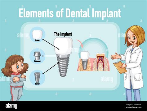 Infographic Of Human In Structure Of The Dental Implant Illustration