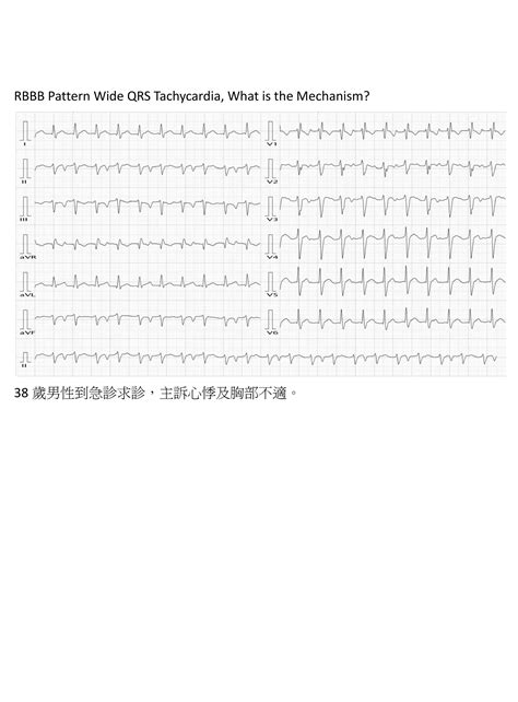 Ecg Wide Qrs Tachycardia Pdf