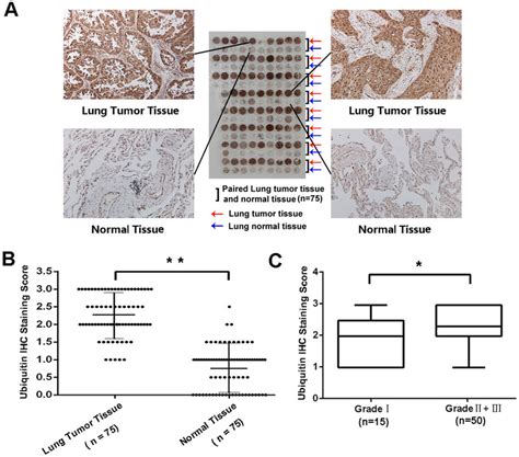 Immunohistochemical IHC Staining Of Ubiquitin In Lung Cancer Tissues