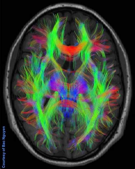 Diffusion Tensor Imaging DTI Siemens 3T MEDizzy