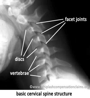 Neck Surgery: Neck Surgery C5 C6 Recovery Time