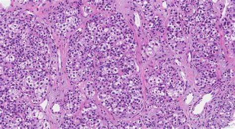 Hepatocellular carcinoma | Atlas of Pathology