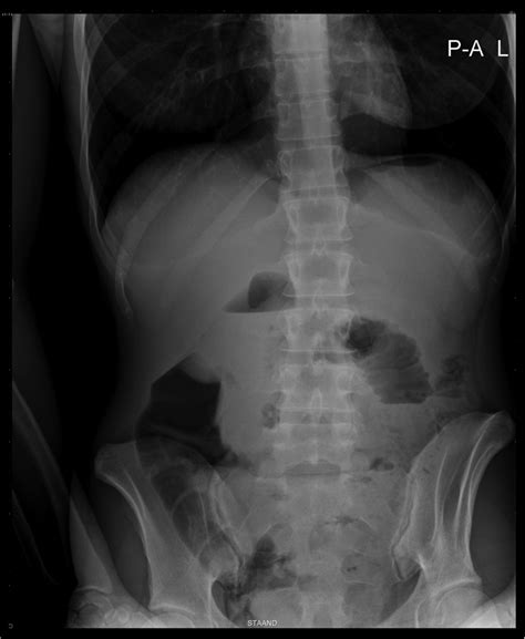 A Young Woman With A Jejuno Jejunal Intussusception Bmj Case Reports