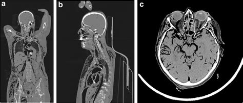 Postmortem Computed Tomography A B Air In The Arterial And Venous