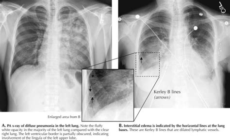 Thorax | Radiology Key