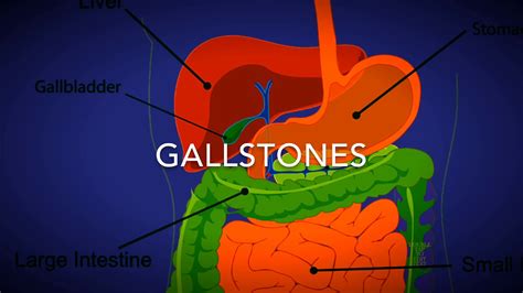 Remove Gallstones Naturally In Hindi Treatment Of Gall Bladder Stones