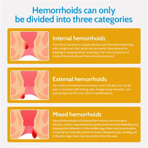 Haemorrhoids Treatment Cream Hemorrhoid Piles Anal Fissure Prolapse Cream Gel EBay