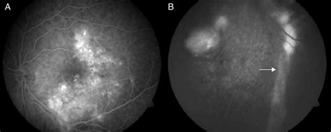 Angiografía fluoresceínica del ojo izquierdo que muestra A