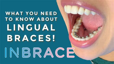 Inbrace Lingual Braces I Explain Cost Process Before And After And