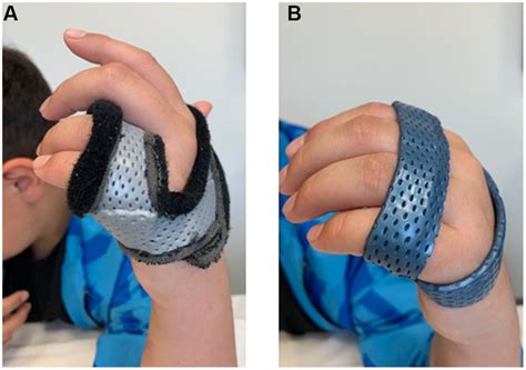 Frontiers Early Post Surgical Rehabilitation And Functional Outcomes