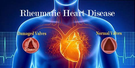 Rheumatic Heart Disease And It S Symptoms Disease Chest Discomfort Heart Disease