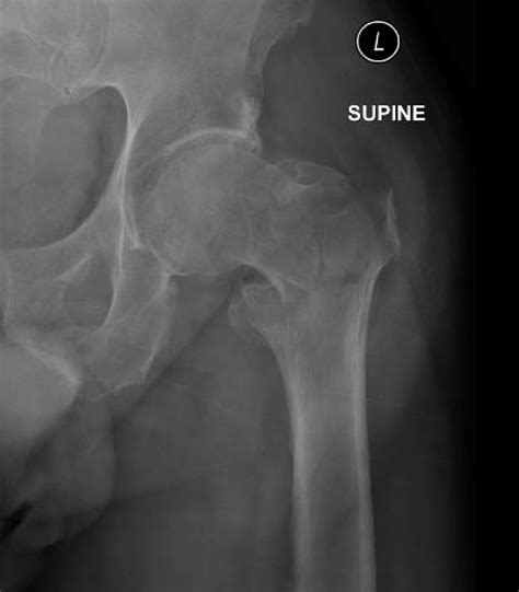 Lesser Trochanter Fracture