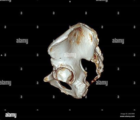 Ct Scan Of Pelvic Bone And Hip Joint 3d Rendering For Diagnosis