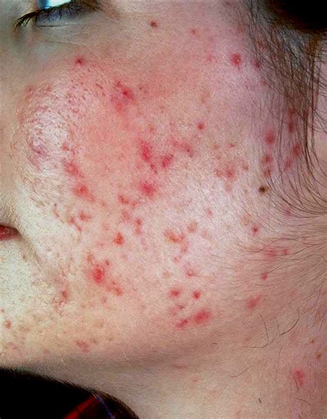 acne excoriee - pictures, photos