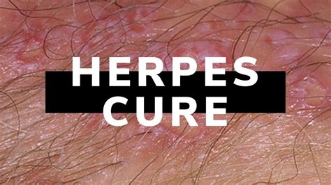 Genital Herpes Cure How To Treat Herpes Natural Remedies At Home Youtube