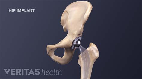 Total Hip Replacement For Hip Arthritis