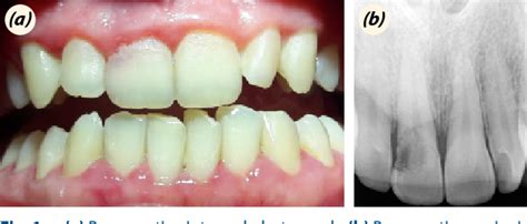 Figure 1 From Management Of Invasive Cervical Root Resorption In A