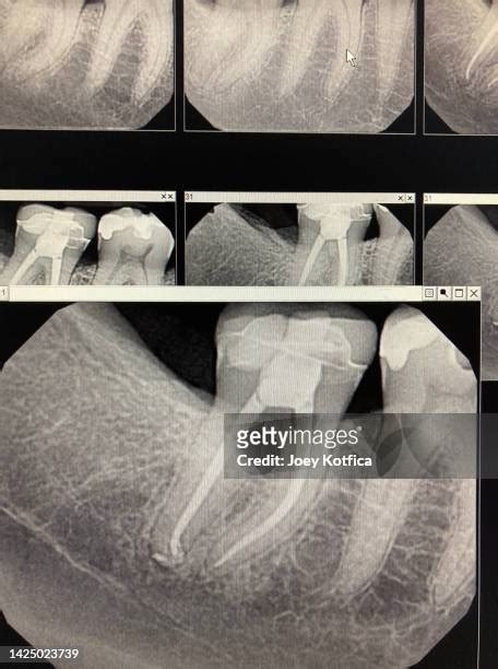 Microscope In Root Canal Treatment Photos And Premium High Res Pictures Getty Images