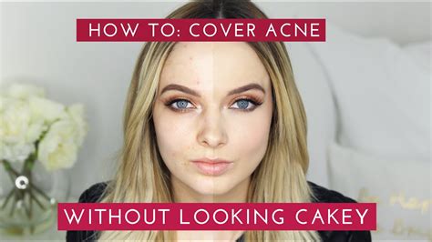 How To Cover Acne And Scars Without Looking Cakey Mypaleskin Youtube