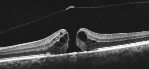 Macular hole - a patient's guide of causes and treatments